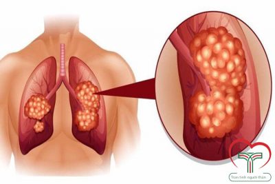 Ung thư phổi giai đoạn đầu có triệu chứng và biểu hiện như thế nào?