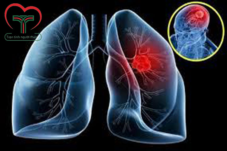 Quy trình và phương pháp chẩn đoán ung thư phổi